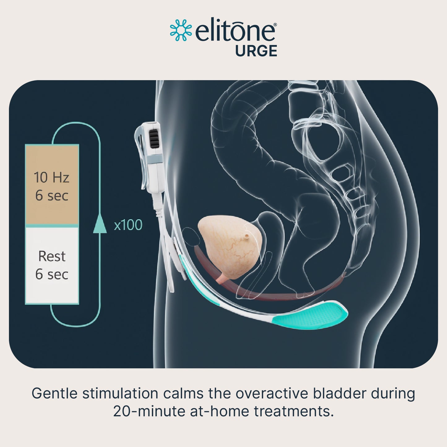 Elitone URGE Treatment